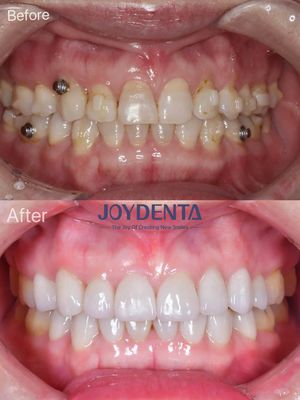 Phục hồi răng miệng bằng veneer sứ