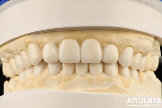 Mắt sinh học Biomimetic thẩm mỹ chẩn đoán Wax-up của veneers