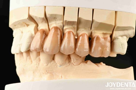 Bionic Teeth Layered Zirconia với Bionic Leaf Micro-Engraving và Multicolor Biomimetic Lamination cho mô phỏng ánh sáng tiên tiến