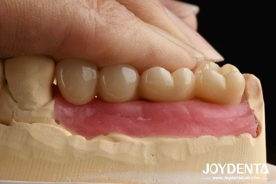 Xử lý siêu chính xác Cấy ghép Zirconia với thiết kế được hỗ trợ bởi AI và đâm răng vú sinh học cho vương miện tích hợp tất cả Zirconium