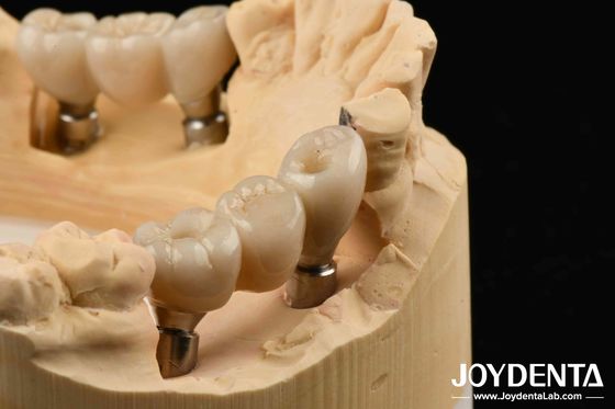 Cấy ghép Zirconia: Sự kết hợp hoàn hảo với răng tự nhiên, không gây dị ứng