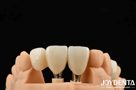 Cấy ghép Zirconia cao cấp cho kết quả thẩm mỹ vượt trội Giải pháp an toàn cho dị ứng và sức mạnh chính xác