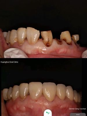 Mão răng sứ Zirconia cao cấp cho các phòng lab nha khoa toàn cầu | JOY Dental Lab
