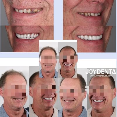 Răng giả zirconia mô phỏng răng thật