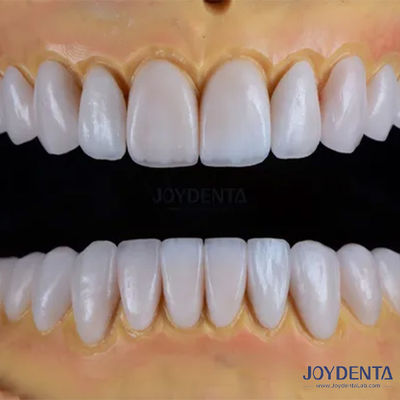Máy làm bằng tay Emax Porcelain Veneers Dẻo mượt Texture Phục hồi răng