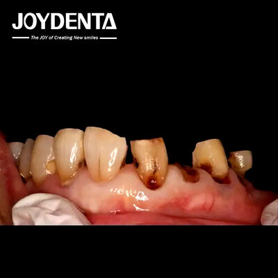 Mão răng sứ Zirconia cao cấp cho các phòng lab nha khoa toàn cầu | JOY Dental Lab