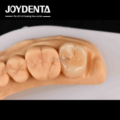 Sức mạnh cao Emax Inlay Onlay A2 Màu sắc lâu dài để phục hồi răng bị hư hỏng