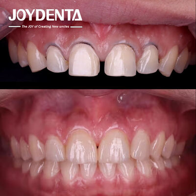 Nha Khoa Thẩm Mỹ Veneer Răng | Gia Công Veneer Sứ & Composite Cao Cấp - Joydentalab