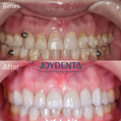 Dán sứ Veneer cho răng bị mất | Dịch vụ phòng thí nghiệm nha khoa cao cấp toàn cầu