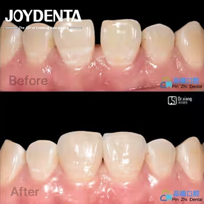 Bảo mật phù hợp Porcelain veneers Điều trị nha khoa Composite nhựa veneers chống vết bẩn