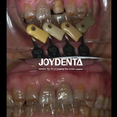 Công nghệ gradient đa lớp