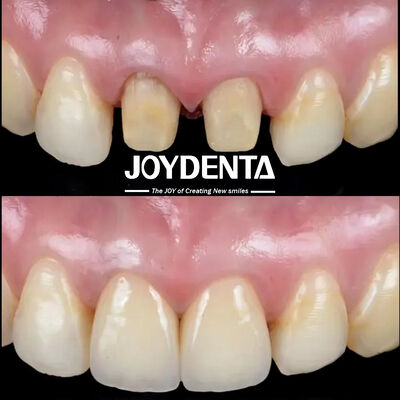 Zirconia nha khoa có khả năng chống gãy cao và Công nghệ Gradient Đa lớp