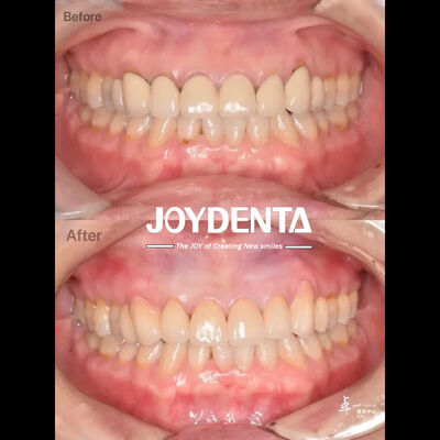 Dental Zirconia cho mô răng miệng an toàn và tương thích CAD / CAM