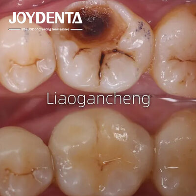 Đồ xốp răng để phục hồi cho người lớn và trẻ em Hiệu suất đặc biệt