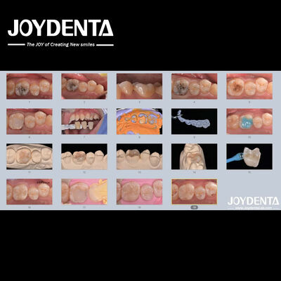 Người lớn Trẻ em Đồ xốp gốm mộc răng tái tạo cho răng bị hư hại