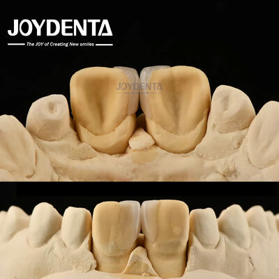 0.2mm Độ dày Microthin Veneers Glass Ceramic Dental Veneers cho răng trước