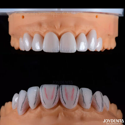 Dental Custom Made Emax Ceramic Veneers với độ chống vết bẩn bóng cao