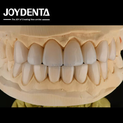 0.3-0.5mm dày Feldspathic Porcelain Veneer Kháng gãy cao nâng cấp nụ cười của bạn